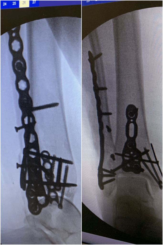 ankle fracture metal